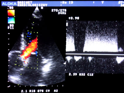 Obraz USG: niedomykalność zastawki aortalnej