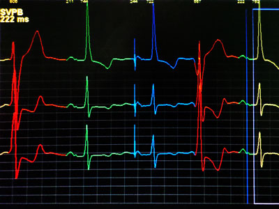 Zapis EKG metodą Holtera: zaburzenia rytmu
