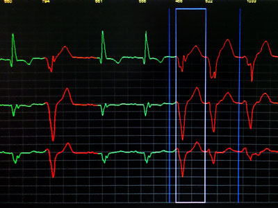 Zapis EKG metodą Holtera: salwa pobudzeń komorowych
